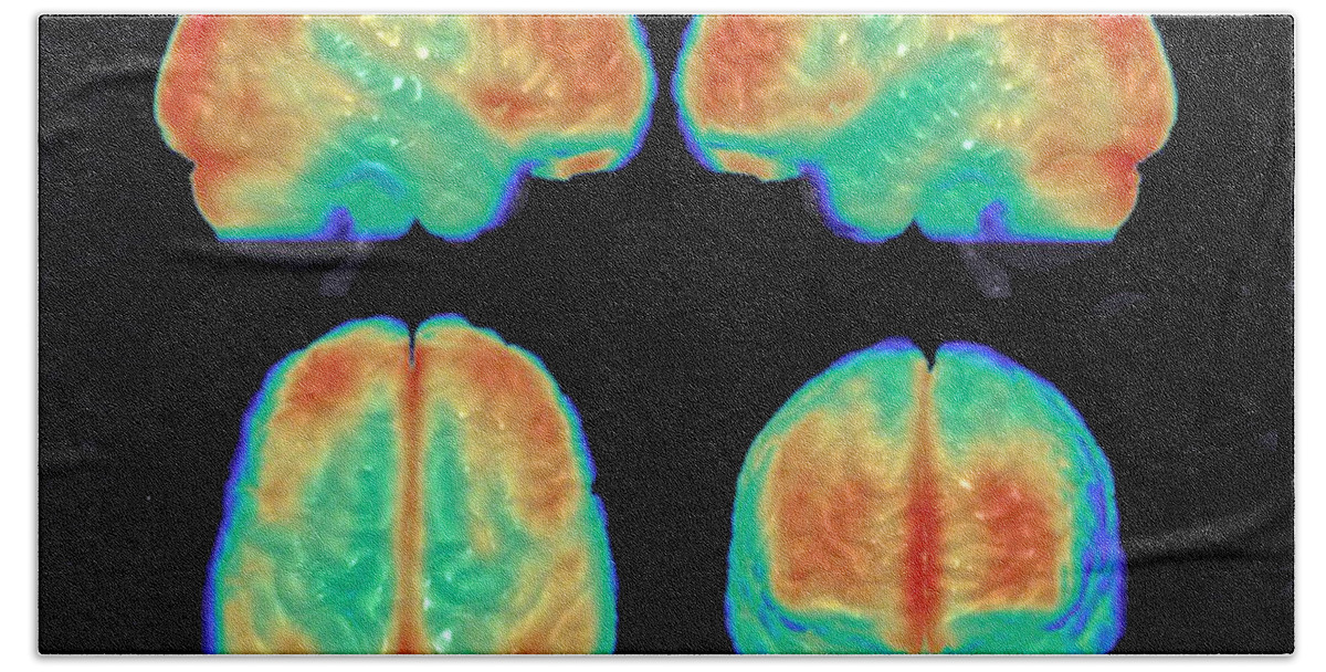 Science Beach Towel featuring the photograph Bipolar Brain, 3d Mri Scan by Science Source