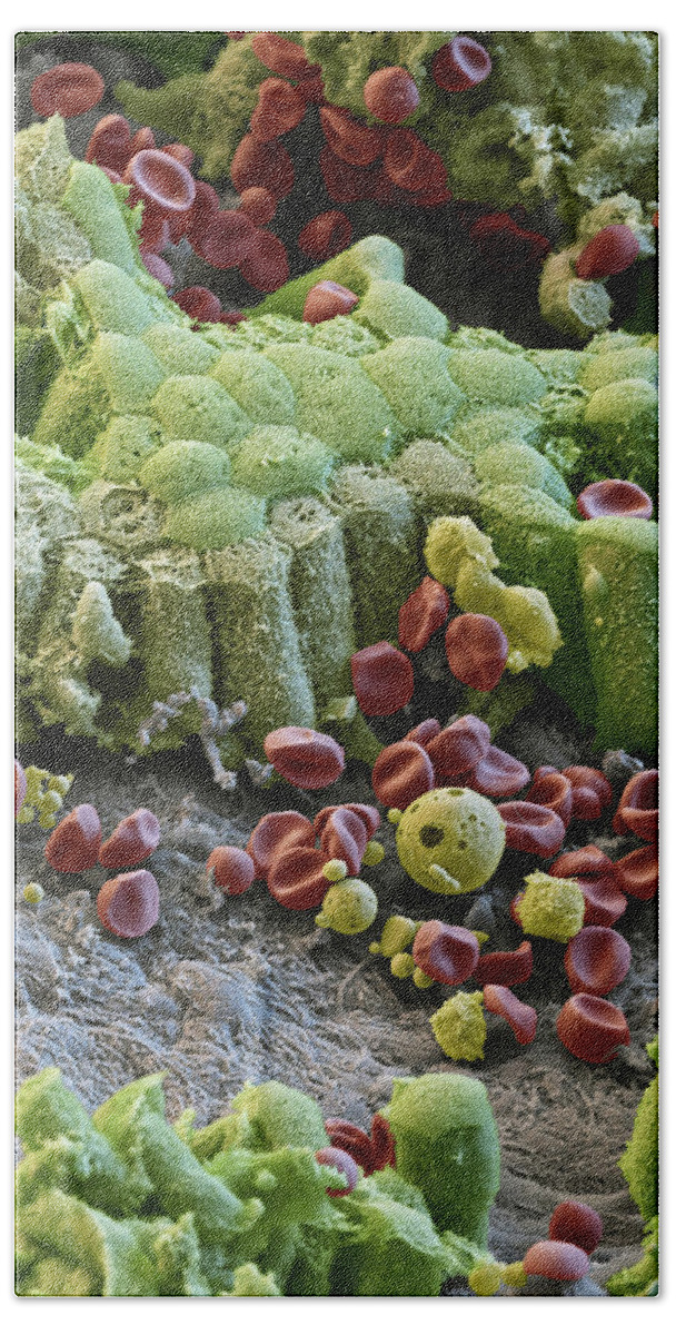 Abnormal Beach Towel featuring the photograph Damaged Gallbladder, Sem #3 by Eye of Science