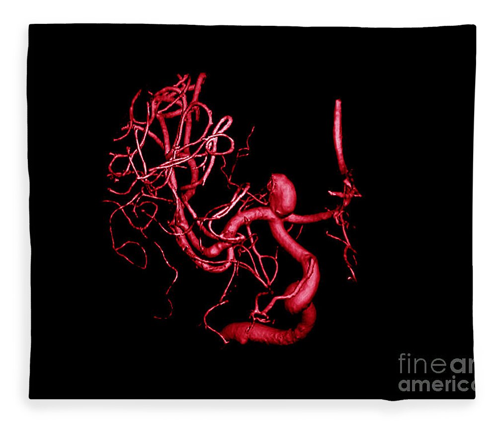 Cerebral Angiogram Fleece Blanket featuring the photograph Cerebral Aneurysm, 3d Scan by Living Art Enterprises