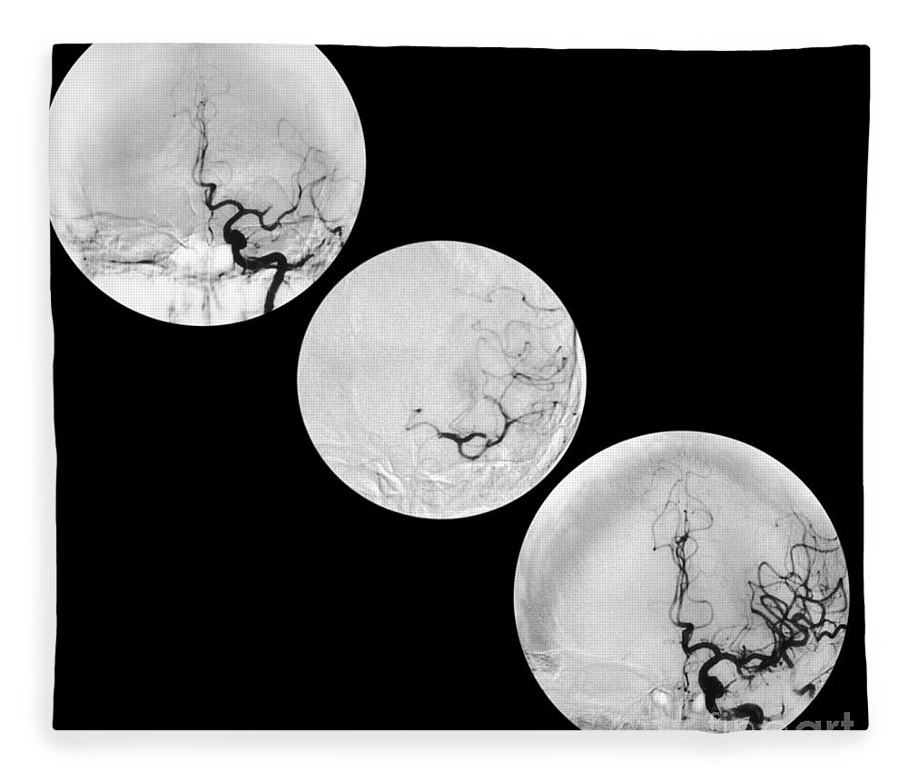 Angiogram Of Stroke Fleece Blanket featuring the photograph Stroke Treatment #1 by Medical Body Scans