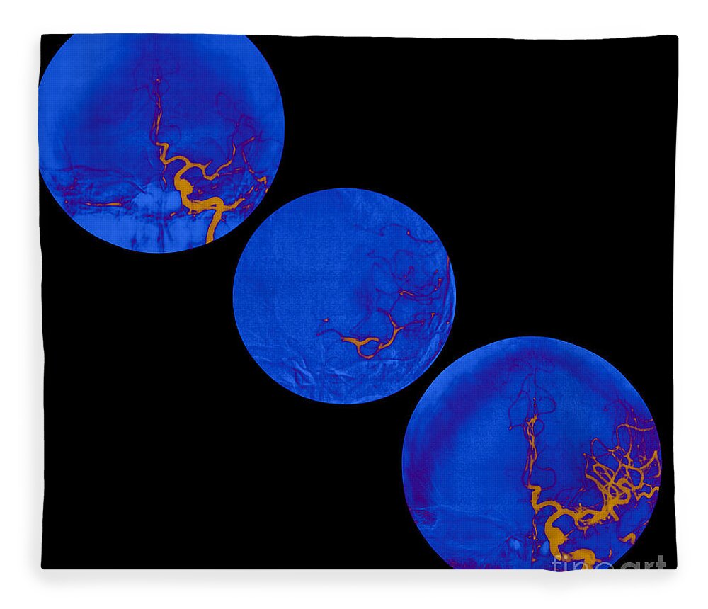 Angiogram Of Stroke Fleece Blanket featuring the photograph Stroke Treatment #3 by Medical Body Scans