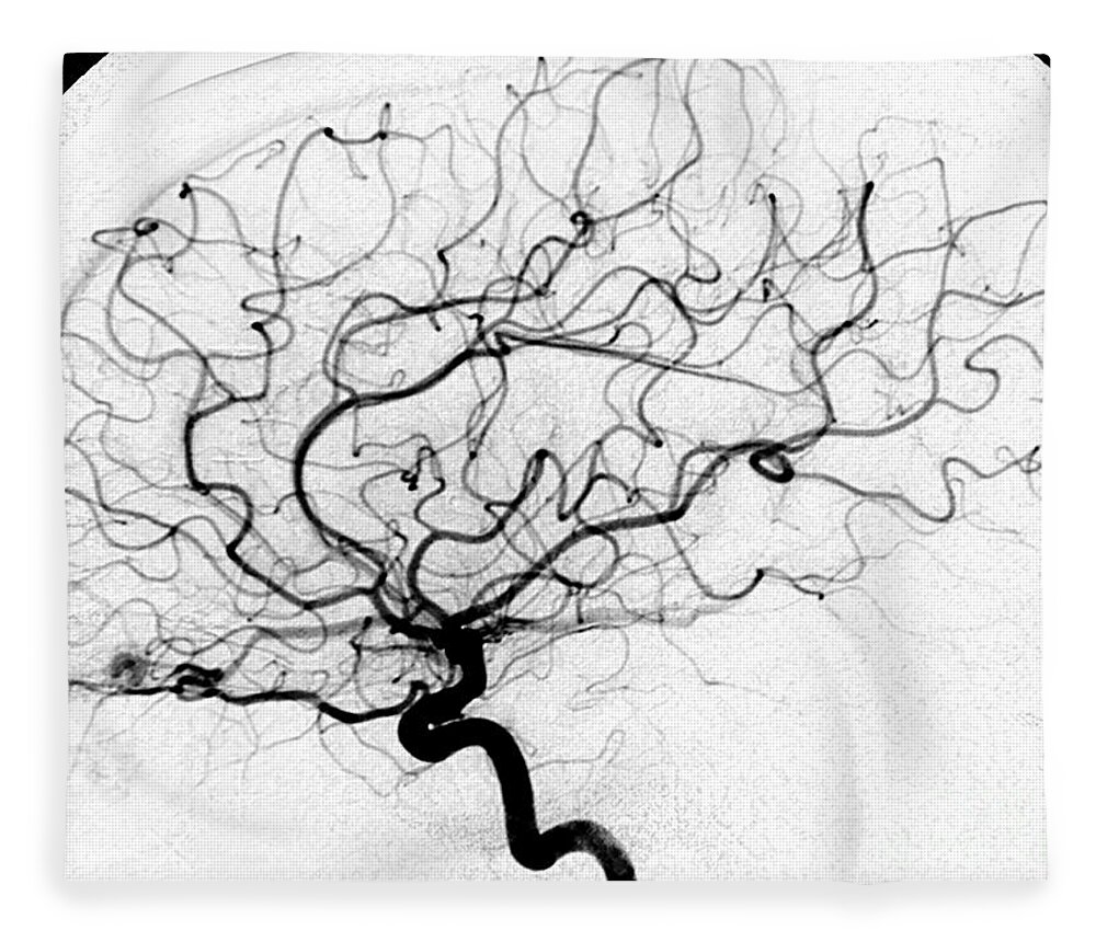 Cerebral Angiogram Fleece Blanket featuring the photograph Dural Arterial Venous Fistula, Angiogram by Living Art Enterprises