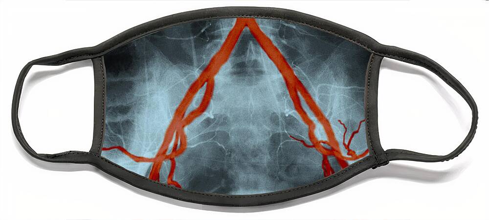 Angiogram Face Mask featuring the photograph Normal Arteriogram #1 by John Watney