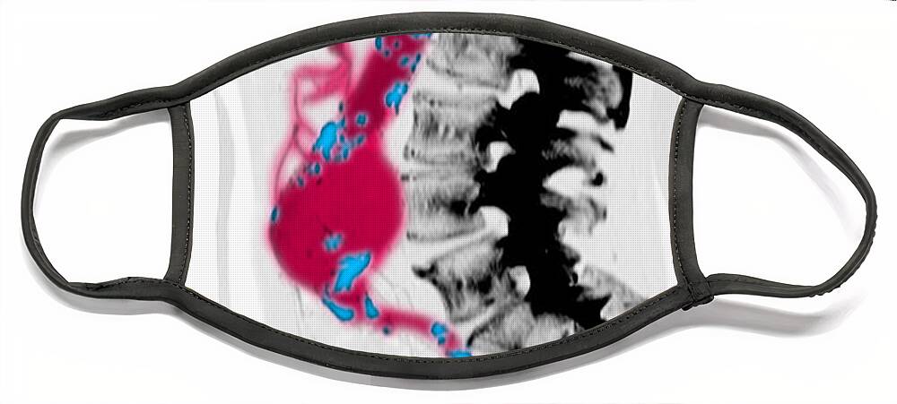 Ct Scan Face Mask featuring the photograph Ct Scan Of Abdominal Aortic Aneurysm #8 by Scott Camazine