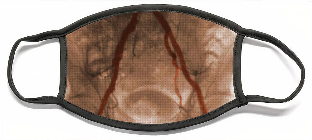 Pelvic Angiogram Face Mask featuring the photograph Angiogram Of Iliac Arteries #1 by Omikron