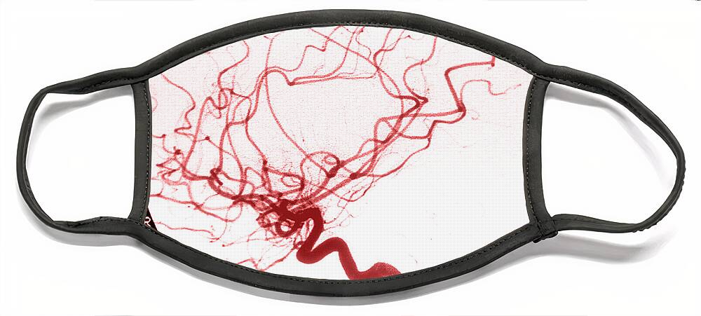 Cerebral Angiogram Face Mask featuring the photograph Internal Carotid Cerebral Angiogram #2 by Medical Body Scans