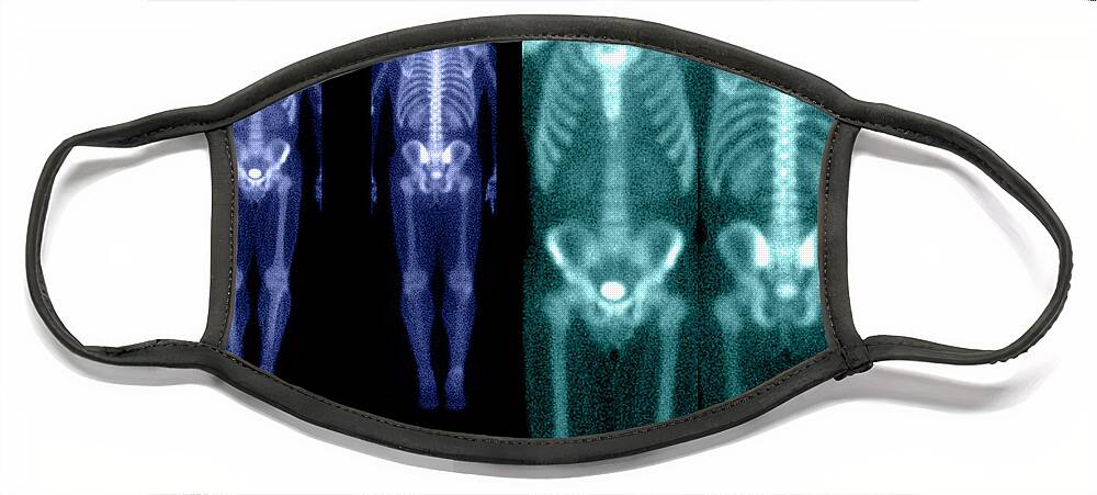 Nuclear Medicine Face Mask featuring the photograph Bone Scan #7 by Medical Body Scans