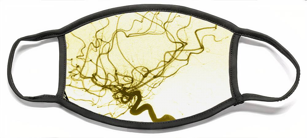 Cerebral Angiogram Face Mask featuring the photograph Internal Carotid Cerebral Angiogram by Medical Body Scans