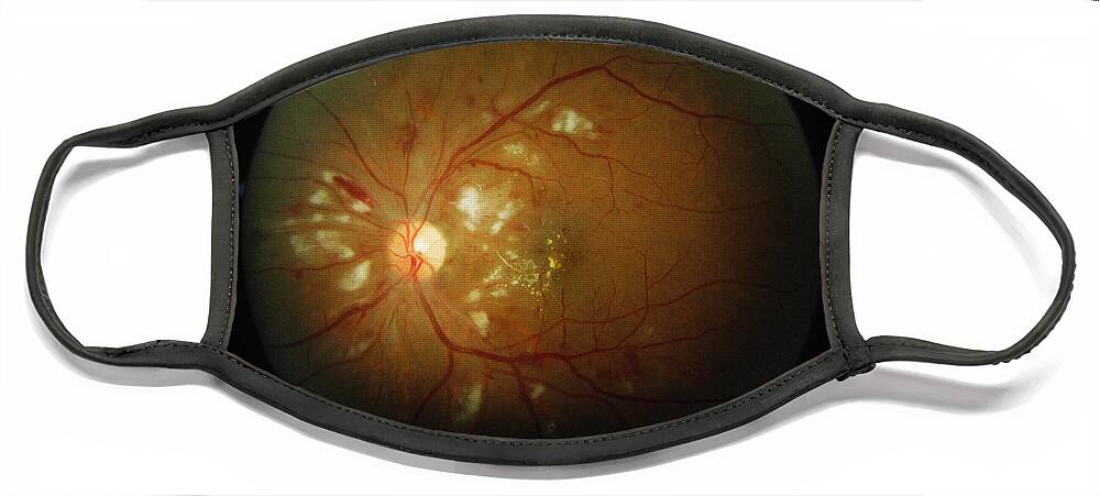 Blood Vessels Face Mask featuring the photograph Cmv Retinitis #1 by Science Source