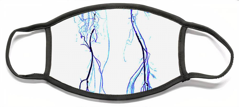 Legs Face Mask featuring the photograph Atherosclerosis, Ct Angiogram #2 by Living Art Enterprises