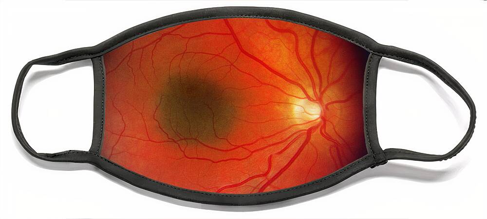 Blood Vessels Face Mask featuring the photograph Nevus In The Retina by Science Source