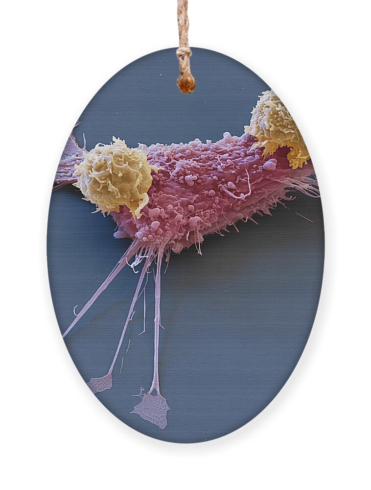 Adenocarcinoma Ornament featuring the photograph Breast Cancer Cell With Car T-cells, Sem by Eye of Science