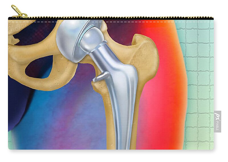 Art Carry-all Pouch featuring the photograph Prosthetic Hip Replacement by Chris Bjornberg