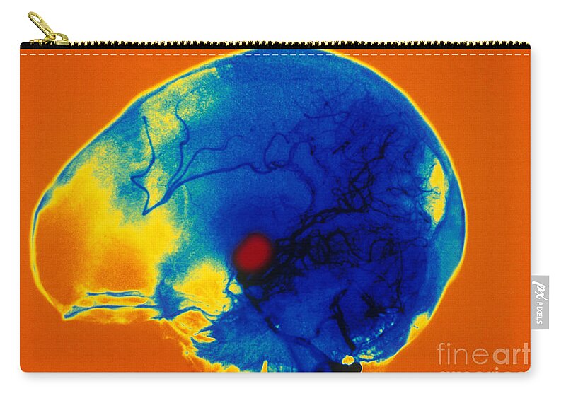 Medical Zip Pouch featuring the photograph Aneurysm #4 by Scott Camazine
