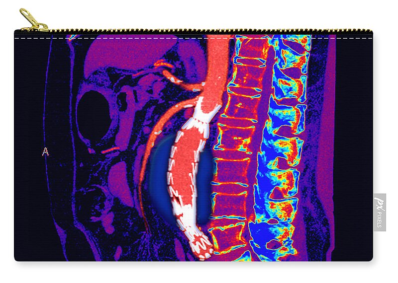 Science Zip Pouch featuring the photograph Abdominal Stent Graft by Living Art Enterprises