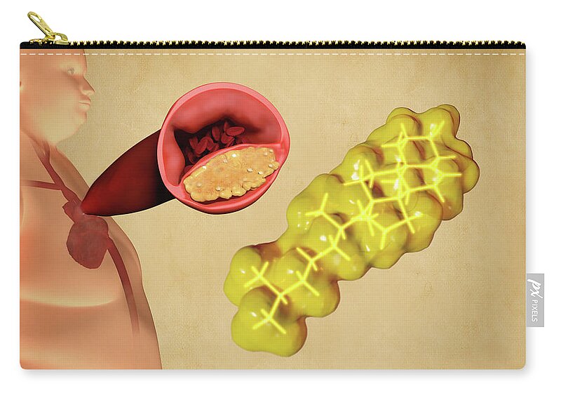 Art Zip Pouch featuring the photograph Cholesterol And Atherosclerosis, Artwork by Juan Gaertner