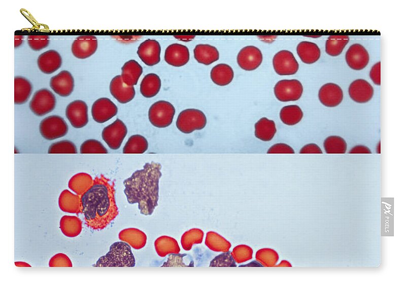 Blood Cell Zip Pouch featuring the photograph Healthy Leukemia Blood Comparison by Spencer Sutton