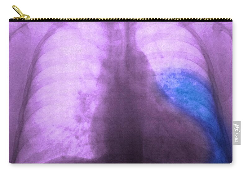 X Ray Zip Pouch featuring the photograph Pneumonia, X Ray by Scott Camazine