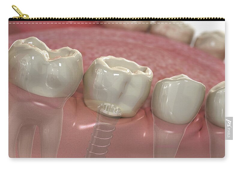 Square Image Zip Pouch featuring the photograph Tooth Implant Lower Jaw by Science Picture Co