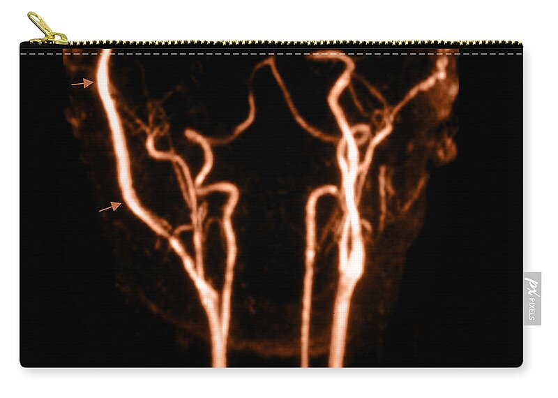 Internal Carotid Artery Zip Pouch featuring the photograph Venous Bypass Graft, Mra by Living Art Enterprises