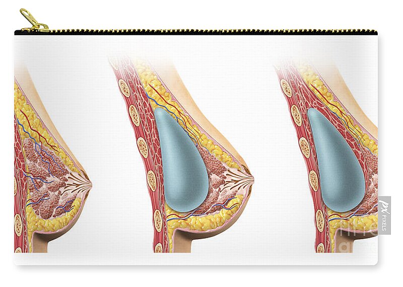 Woman Breast Implant Cross Section Zip Pouch by Leonello Calvetti