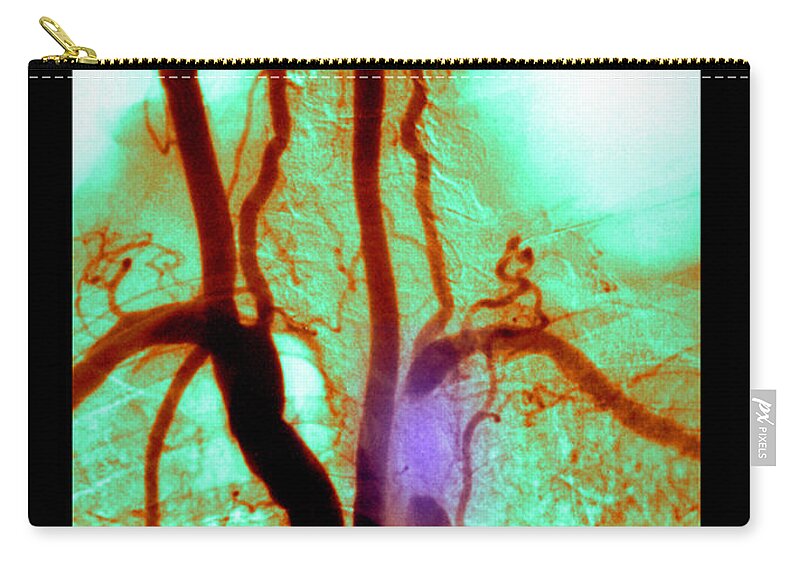 Abnormal Angiogram Zip Pouch featuring the photograph Aortic Arch Angiogram #1 by Medical Body Scans