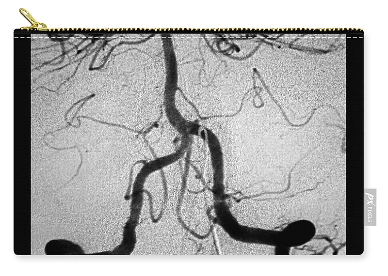 Cerebral Zip Pouch featuring the photograph Cerebral Angiogram by Medical Body Scans