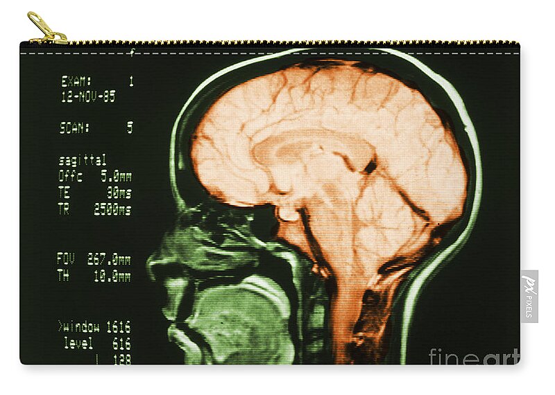 Angiography Zip Pouch featuring the photograph Cerebral Angiography #1 by Science Source