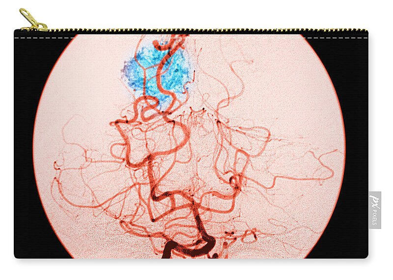 Abnormal Cerebral Angiogram Zip Pouch featuring the photograph Occipital Lobe Avm #1 by Medical Body Scans