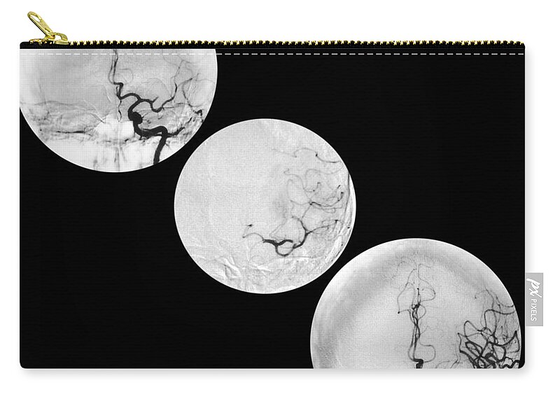 Angiogram Of Stroke Zip Pouch featuring the photograph Stroke Treatment by Medical Body Scans