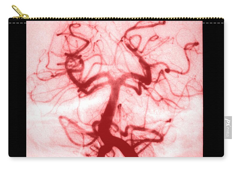 Abnormal Cerebral Angiogram Zip Pouch featuring the photograph Angiogram Of Embolus In Cerebral Artery #2 by Medical Body Scans