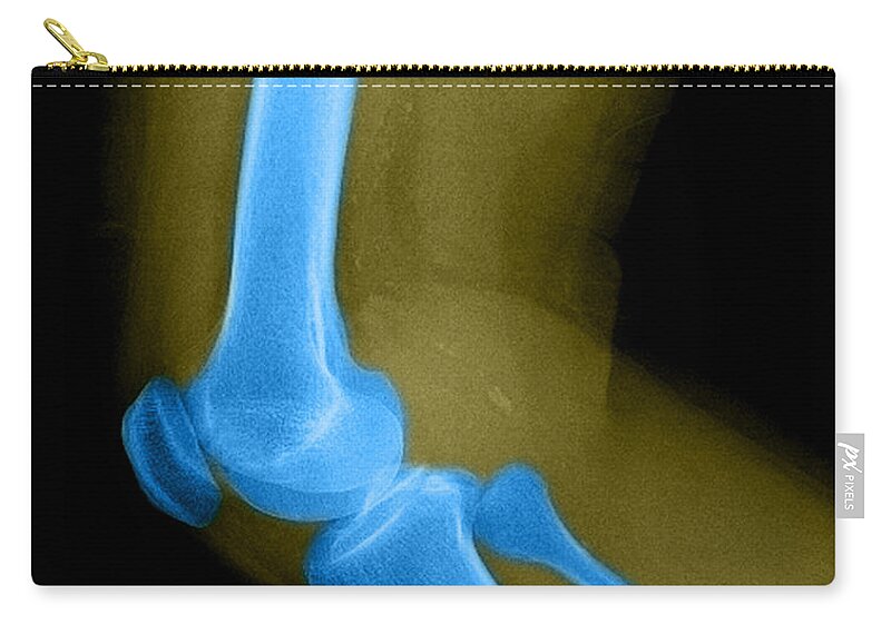Bone Zip Pouch featuring the photograph Lateral X-ray Of The Knee #2 by Medical Body Scans