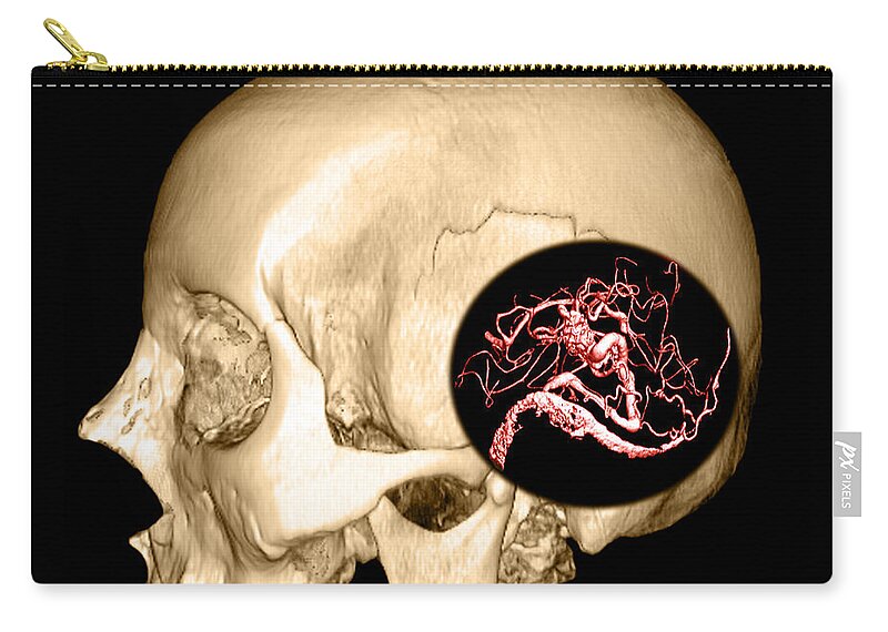 3d Ct Reconstruction Zip Pouch featuring the photograph 3d Image Of Skull And Brain Avm by Medical Body Scans