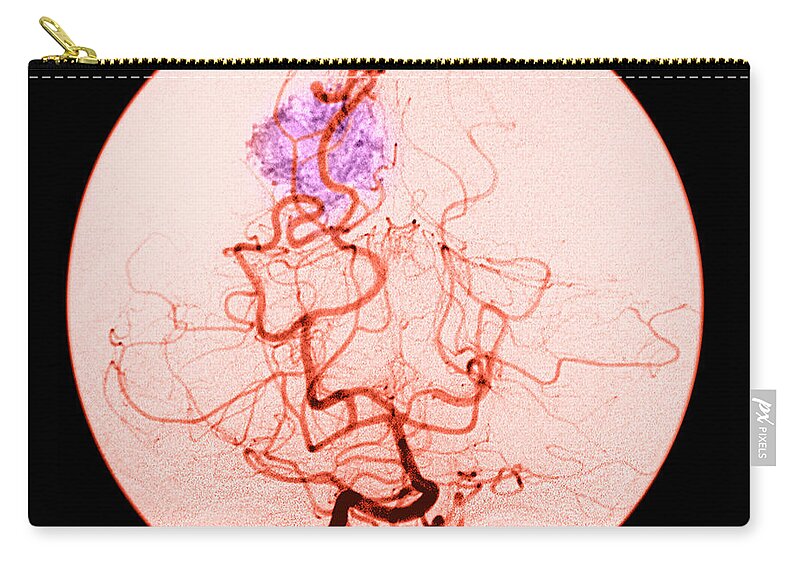Abnormal Cerebral Angiogram Zip Pouch featuring the photograph Occipital Lobe Avm #3 by Medical Body Scans