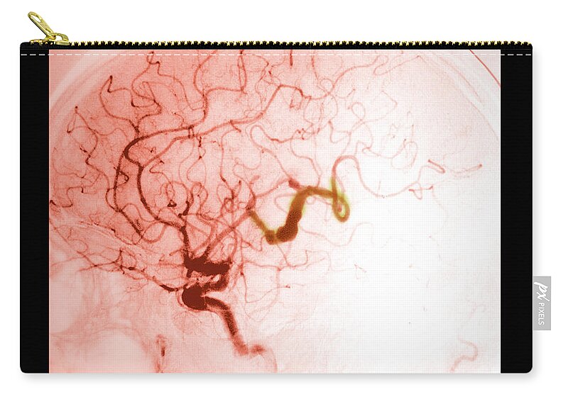Abnormal Brain Zip Pouch featuring the photograph Serpentine Aneurysm #3 by Medical Body Scans