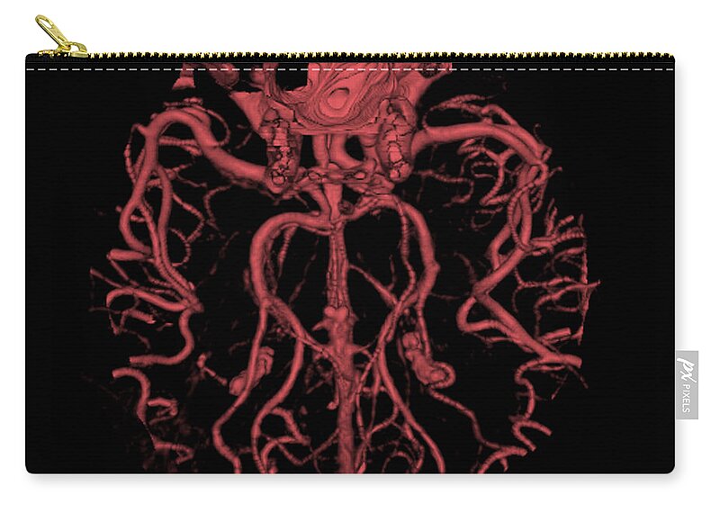 Intracranial Cta Zip Pouch featuring the photograph Intracranial Ct Angiogram #4 by Medical Body Scans