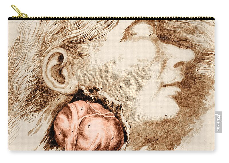 1800s Zip Pouch featuring the photograph Aneurysm Of The Carotid Artery by Science Source