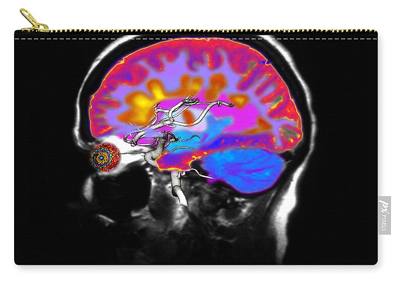 Mri Zip Pouch featuring the photograph Brain With Multiple Sclerosis by Medical Body Scans