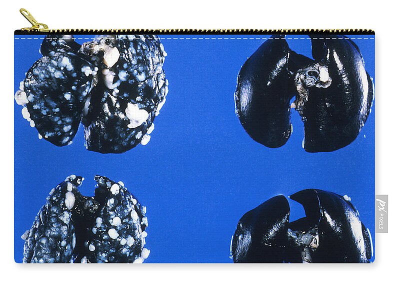 Cancer Zip Pouch featuring the photograph Cancer In Mouse Lungs by Science Source