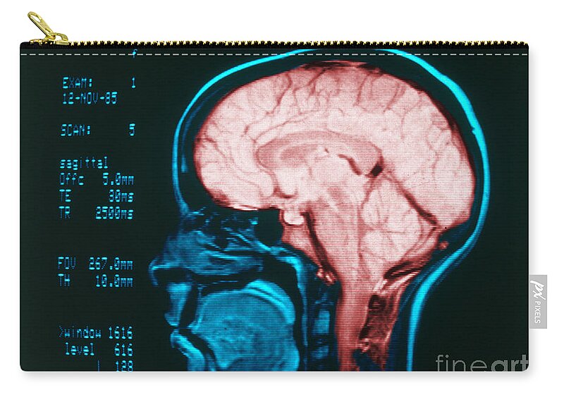 Angiography Zip Pouch featuring the photograph Cerebral Angiography by Science Source