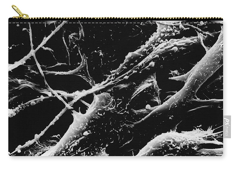 Melanoma Zip Pouch featuring the photograph Human Melanoma by Science Source
