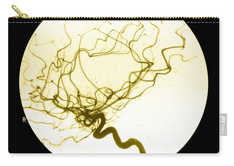 Cerebral Angiogram Zip Pouch featuring the photograph Internal Carotid Cerebral Angiogram by Medical Body Scans