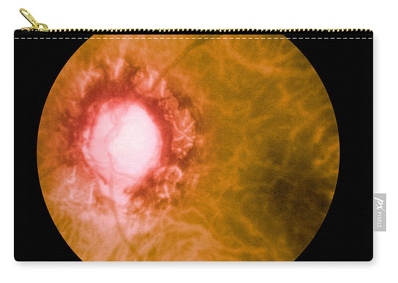 Bacteria Carry-all Pouch featuring the photograph Retina Infected By Syphilis by Science Source