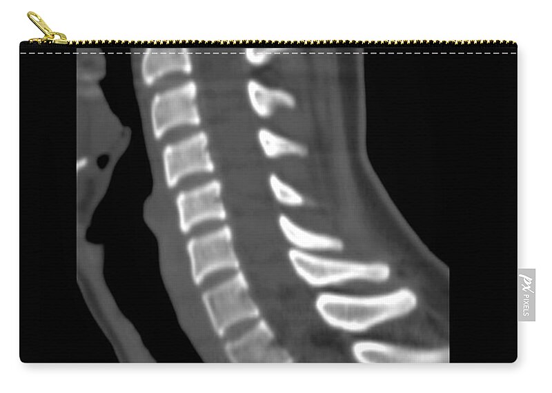 Medical Zip Pouch featuring the photograph Normal Cervical Spine by Medical Body Scans
