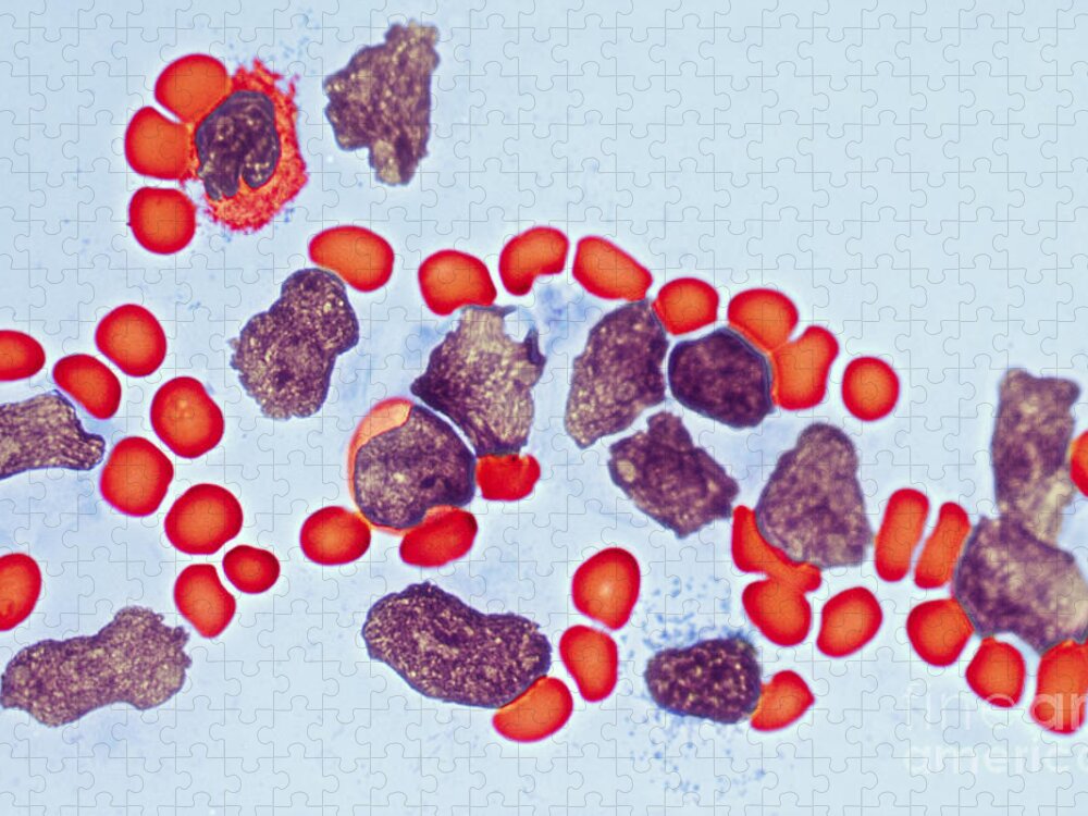 Leukemia Jigsaw Puzzle featuring the photograph Leukemia #1 by Biology Pics