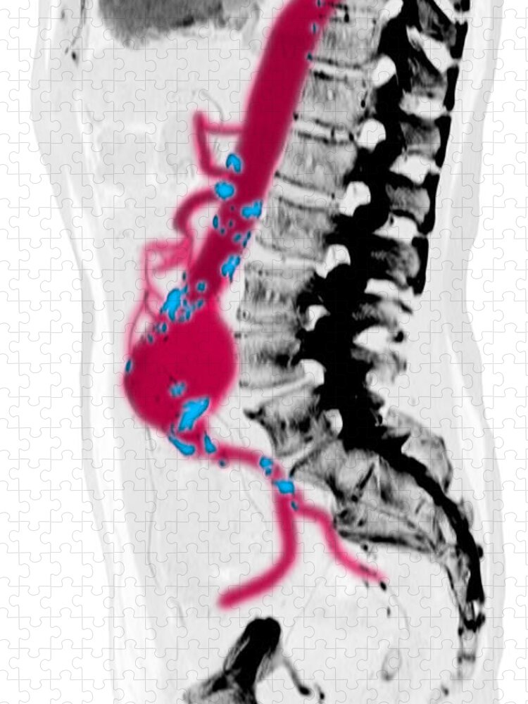 Ct Scan Jigsaw Puzzle featuring the photograph Ct Scan Of Abdominal Aortic Aneurysm #8 by Scott Camazine