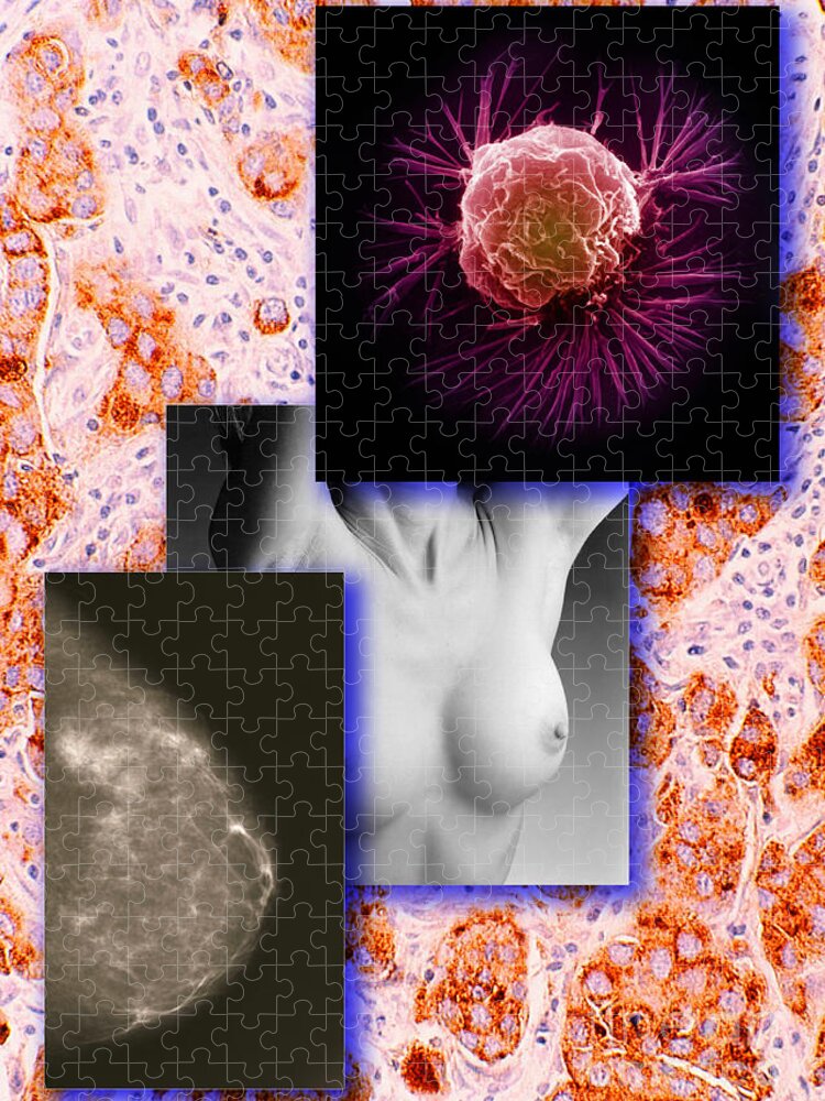 Pathology Jigsaw Puzzle featuring the photograph Breast Cancer Montage by Scott Camazine