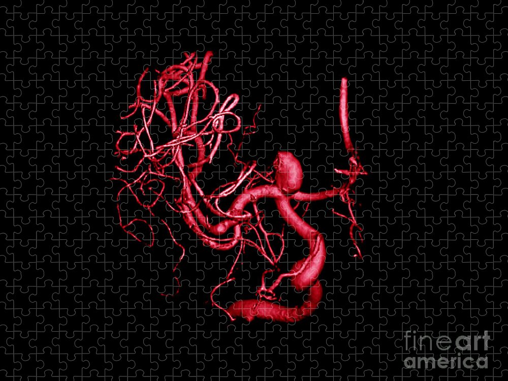 Cerebral Angiogram Jigsaw Puzzle featuring the photograph Cerebral Aneurysm, 3d Scan by Living Art Enterprises