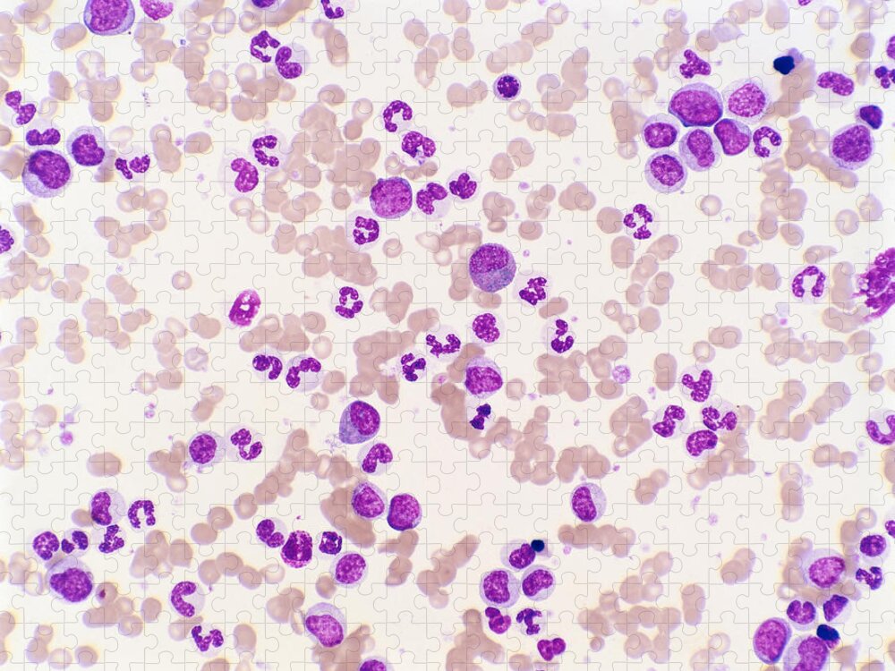 Chronic Granulocytic Leukemia Jigsaw Puzzle featuring the photograph Chronic Granulocytic Leukemia by Joaquin Carrillo-Farga