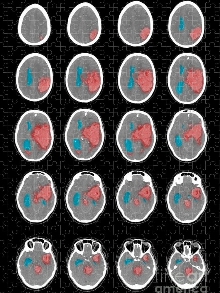 Scan Jigsaw Puzzle featuring the photograph Ct Scan Of Intracranial Hemorrhage by Scott Camazine